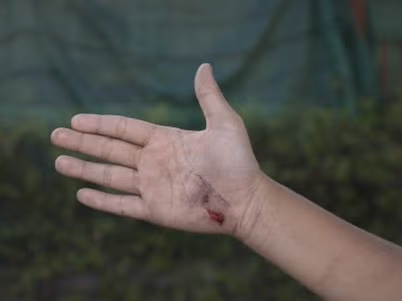 Dog Bite Attorney in Tracy, CA