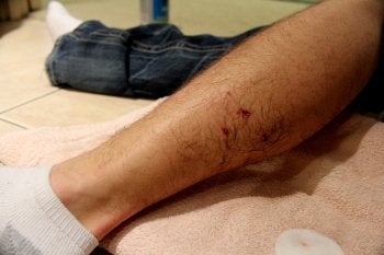 Injured man with a leg bandage, highlighting a Dog Bite Case in Tracy, CA